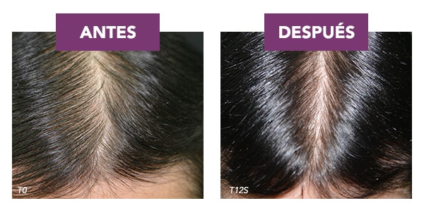 2.5 VECES MENOS* CAÍDA DE CABELLO